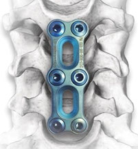 Implantes Oseos Osteocor