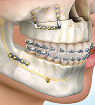 Implantes Oseos Osteocor