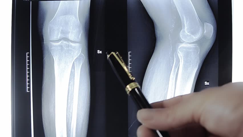 implantes oseos osteocor