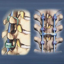 Implantes Oseos Osteocor