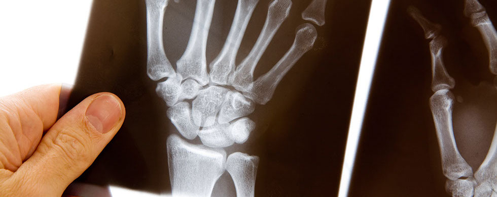 Implantes Oseos Osteocor